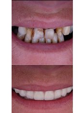 All-on-6 Dental Implants - JollyDent Fethiye
