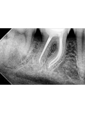 Root Canals - Gocek Dent Oral and Dental Health Clinic