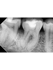 Root Canals - Gocek Dent Oral and Dental Health Clinic
