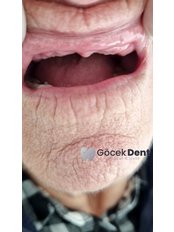 Dentures - Gocek Dent Oral and Dental Health Clinic