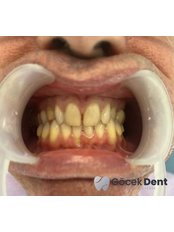 Zirconia Crown - Gocek Dent Oral and Dental Health Clinic
