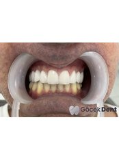 Zirconia Crown - Gocek Dent Oral and Dental Health Clinic