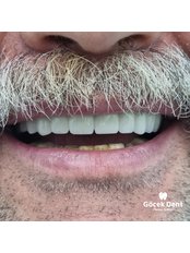 All-on-6 Dental Implants - Gocek Dent Oral and Dental Health Clinic