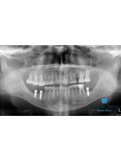 Dental Implants - Gocek Dent Oral and Dental Health Clinic