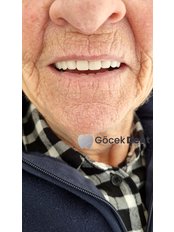 Dentures - Gocek Dent Oral and Dental Health Clinic