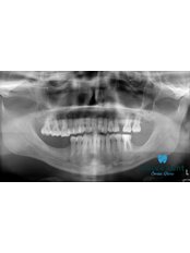 Dental Implants - Gocek Dent Oral and Dental Health Clinic
