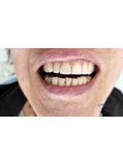 White Filling - Gocek Dent Oral and Dental Health Clinic