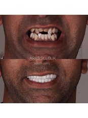 Dental Crowns - Aras Selcuk Advanced Dentistry