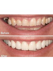 Smile Makeover - Marmaris Dental Center