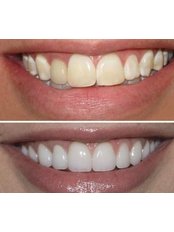 Laser Teeth Whitening - Marmaris Dental Center