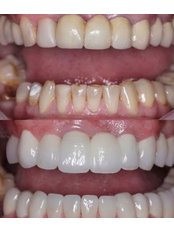 Zirconia Crown - Marmaris Dental Center