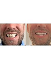 Dental Crowns - Perfect Smile Dental Clinic Marmaris