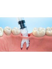 Bone Graft - Perfect Smile Dental Clinic Marmaris