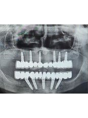 All-on-6 Dental Implants - Arzu Smile Studio