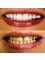 YALOVA DENTALPARK - Dental Smile Design with Implant Treatments in Turkey, Yalova Dental Park 