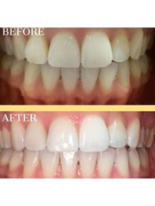 Teeth Polishing - Smiletech Dental Clinic