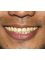 Prosmiles Teeth Whitening - Before Teeth Whitening 