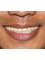 Prosmiles Teeth Whitening - After Teeth Whitening 