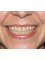 Prosmiles Teeth Whitening - Before Teeth Whitening 