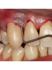 Periodontitis Treatment - The Dental Hygiene Suite