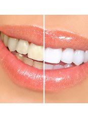 Teeth Whitening - The Dental Hygiene Suite