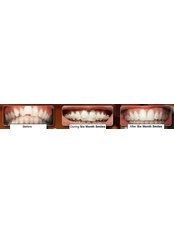 Six Month Smiles™ - Cavehill Dental Care