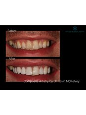 Composite Artistry Veneers - Hillsborough Dental