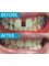 Dental Centre Bournemouth - Invisalign Space Closure - Before & After 