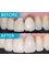 Dental Centre Bournemouth - Teeth Restoration - Before & After 