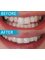 Dental Centre Bournemouth - Six Month Smile - Before & After 