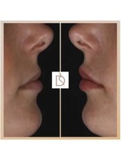 Non-Surgical Rhinoplasty (Nose Filler) - Dental on the Banks