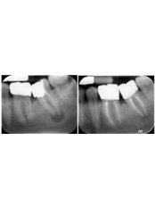 Root Canal Treatment - Dental on the Banks