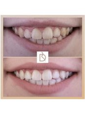 Teeth Whitening - Dental on the Banks