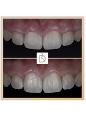 Non-Surgical Periodontal Therapy - Dental on the Banks