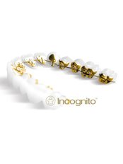 Incognito™ (Lingual) Braces - Dental on the Banks