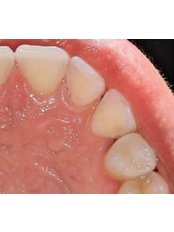Fillings - Coxhoe Dental Practice