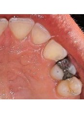 Fillings - Coxhoe Dental Practice