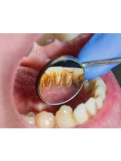 Air Abrasion - Coxhoe Dental Practice
