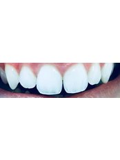 Composite Bonding - Coxhoe Dental Practice
