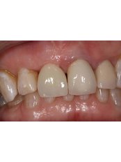 Dental Implants - Single	tooth - Elliott McCarthy Dental Care