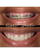Braces - Dr Rishi Joshi Dentistry