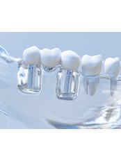 Dental Implants - Dr Rishi Joshi Dentistry