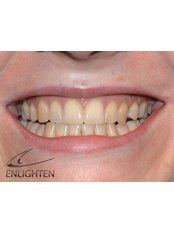IN SURGERY WHITENING - Billericay Dental Care
