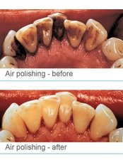 Airflow Stain Removal - Smile restoration - Billericay Dental Care