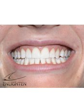 IN SURGERY WHITENING - Billericay Dental Care