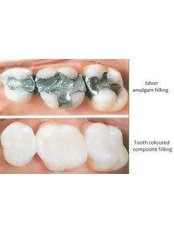 White Fillings - Billericay Dental Care