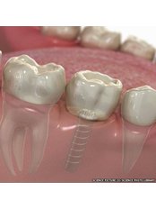 Single Implant - Billericay Dental Care