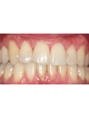 Invisalign™ - Cwtch Dental Care