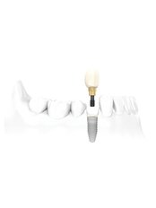 Implant fixture - Arnica Dental Care