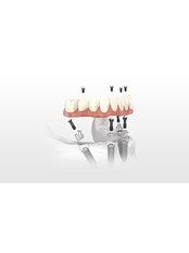 Implant fixture - Arnica Dental Care